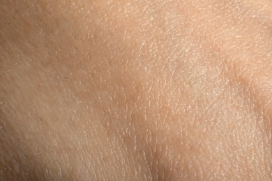 Photo of Closeup view of dry human skin as background