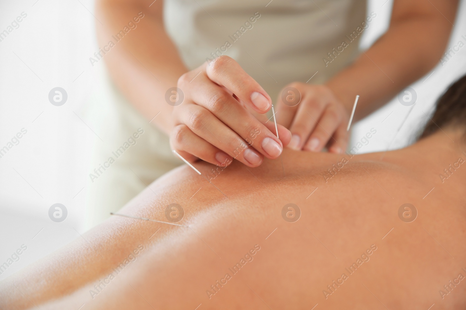 Photo of Young woman undergoing acupuncture treatment in salon, closeup