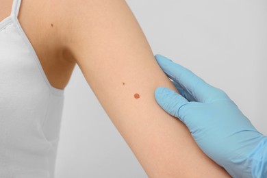 Dermatologist examining patient's birthmark on beige background, closeup