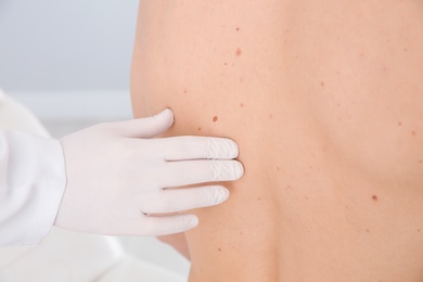 Dermatologist examining patient's birthmark in clinic, closeup