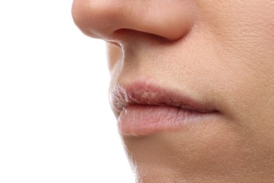 Photo of Woman suffering from herpes on white background, closeup