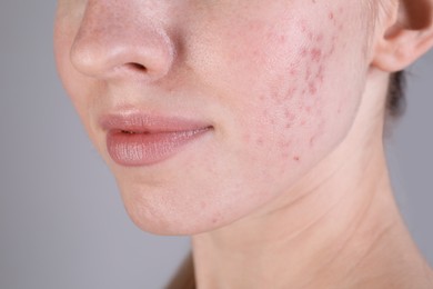 Photo of Young woman with acne problem on light grey background, closeup