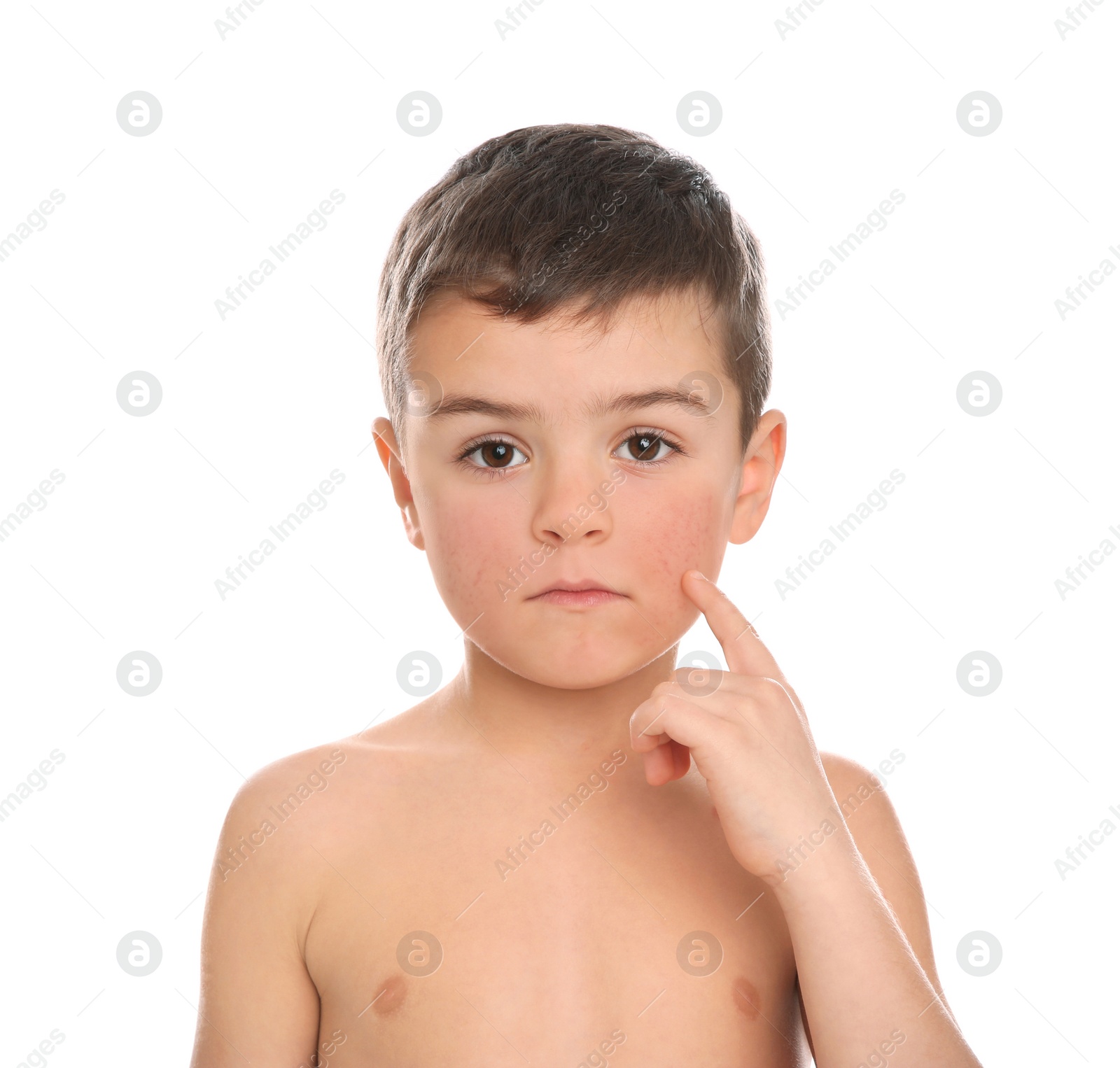 Image of Cute little boy with allergy symptoms on cheeks against white background
