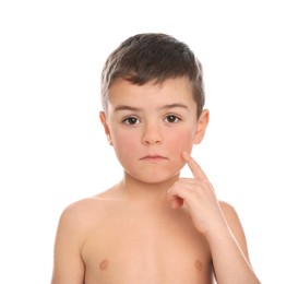 Image of Cute little boy with allergy symptoms on cheeks against white background
