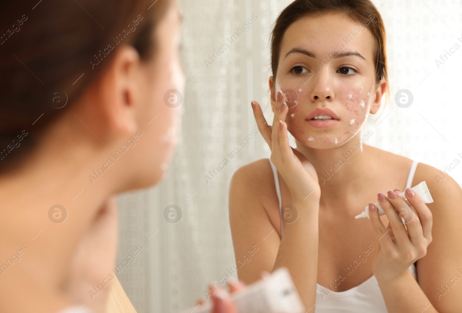 Photo of Teen girl with acne problem applying cream near mirror in bathroom