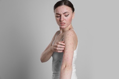 Woman with rash suffering from monkeypox virus on light grey background