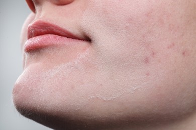 Woman with dry skin on face against light background, closeup