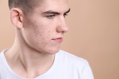 Young man with acne problem on beige background, closeup