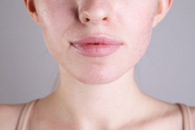 Photo of Young woman with acne problem on light grey background, closeup