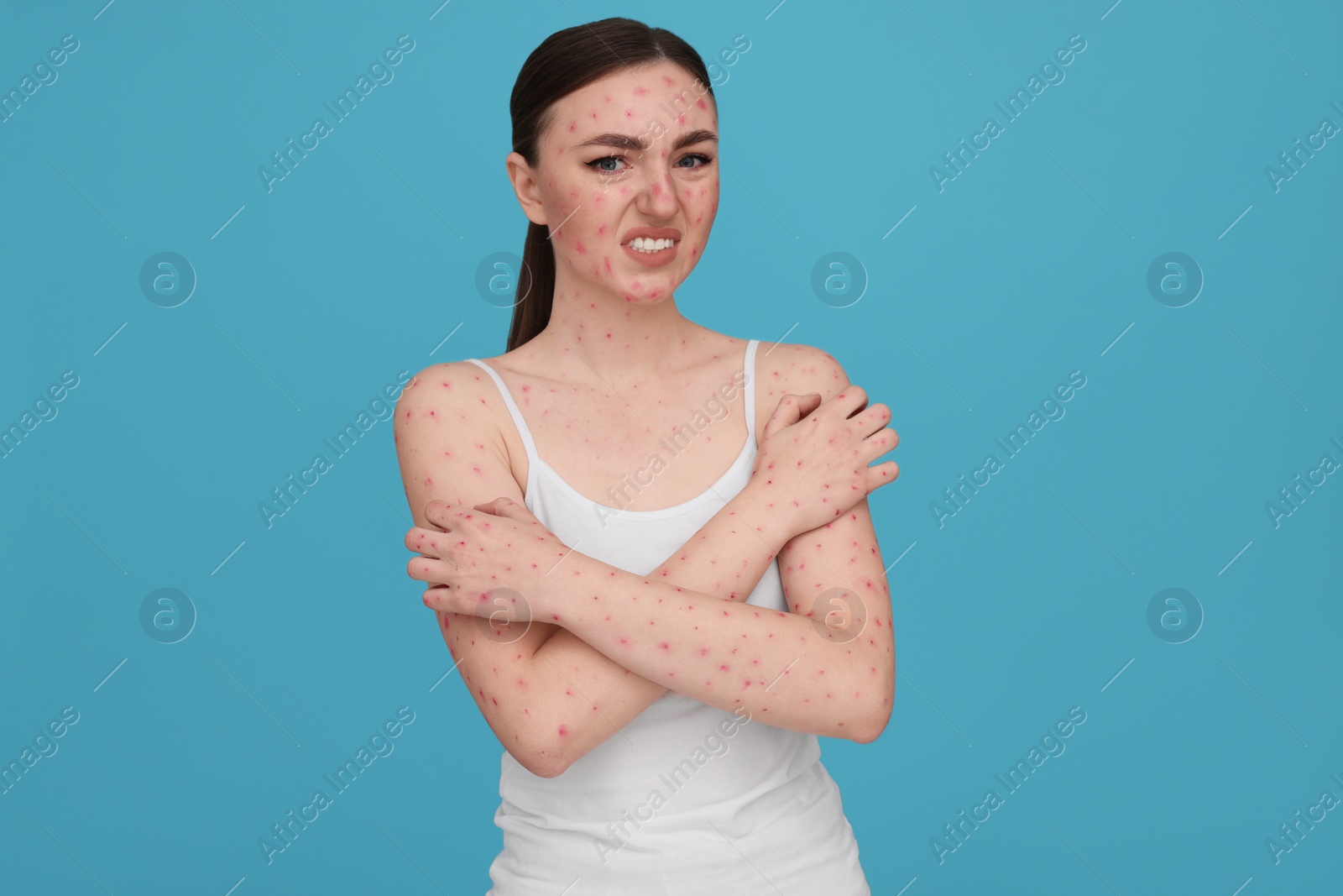 Photo of Woman with rash suffering from monkeypox virus on light blue background