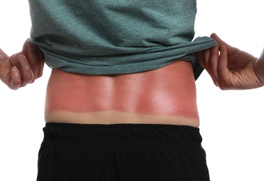 Photo of Man with sunburned skin on white background, closeup