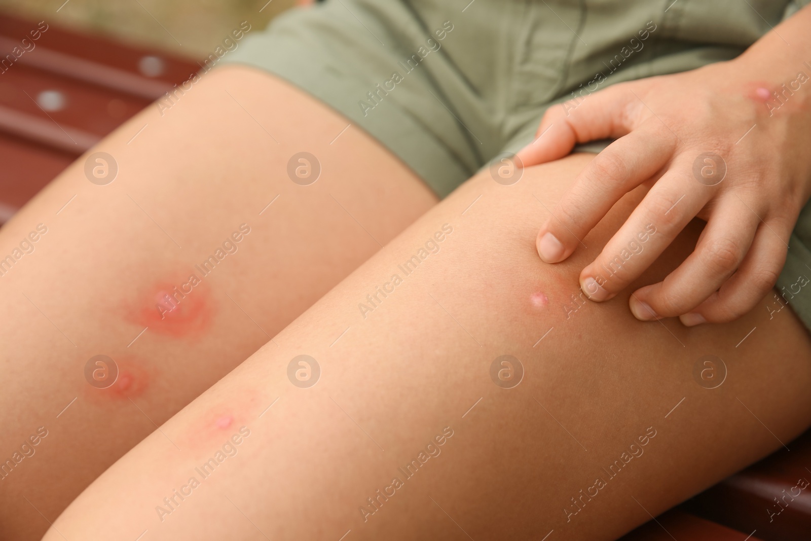 Photo of Woman scratching leg with insect bite outdoors, closeup