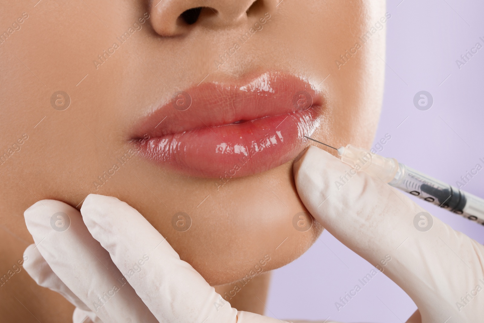 Photo of Young woman getting lips injection on lilac background, closeup