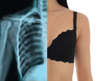 Woman in bra, chest closeup, half x-ray photograph. Medical check