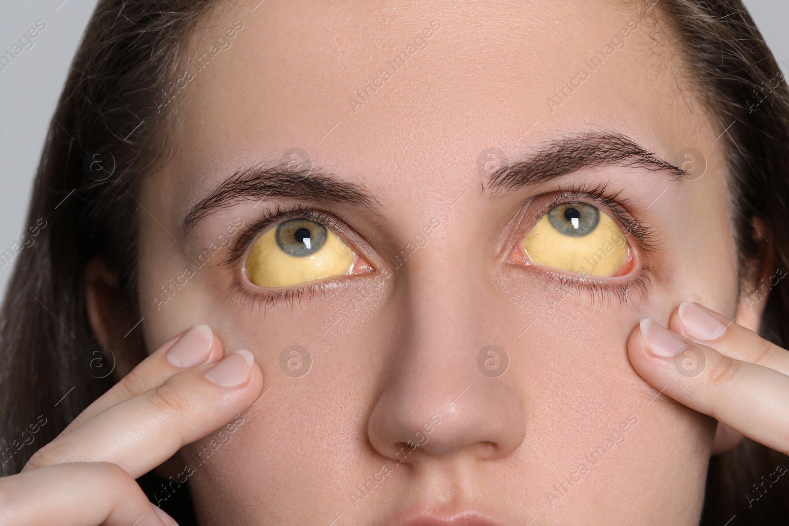 Photo of Woman with yellow eyes on light background, closeup. Symptom of hepatitis