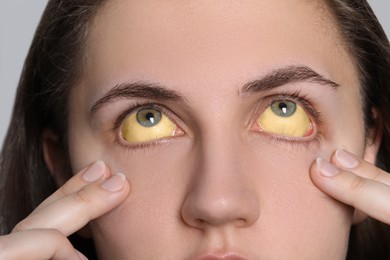 Photo of Woman with yellow eyes on light background, closeup. Symptom of hepatitis