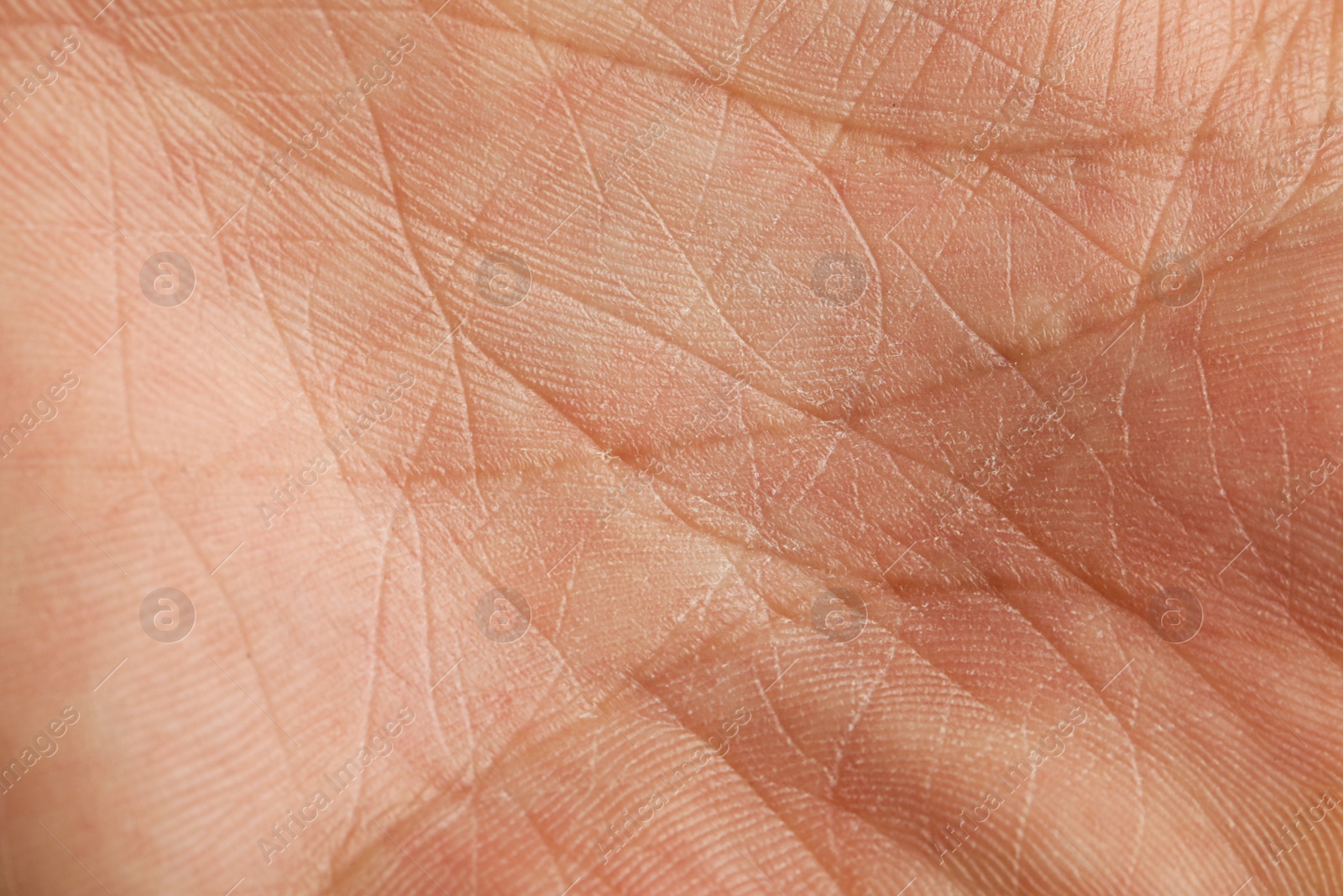 Photo of Closeup view of human palm with dry skin
