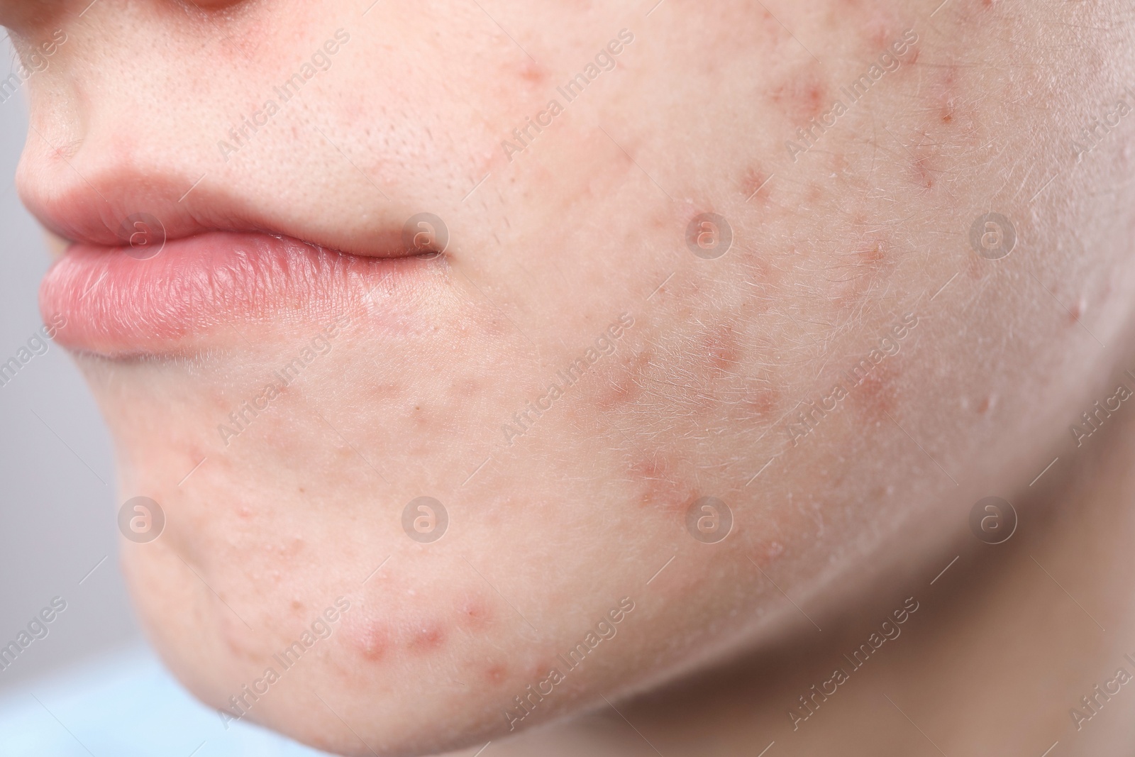 Photo of Young man with acne problem on grey background, closeup