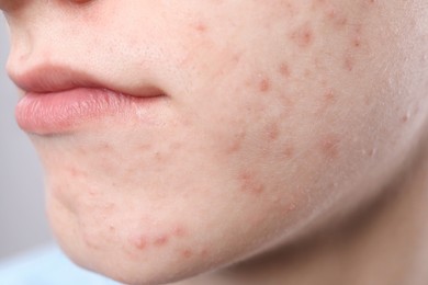 Young man with acne problem on grey background, closeup