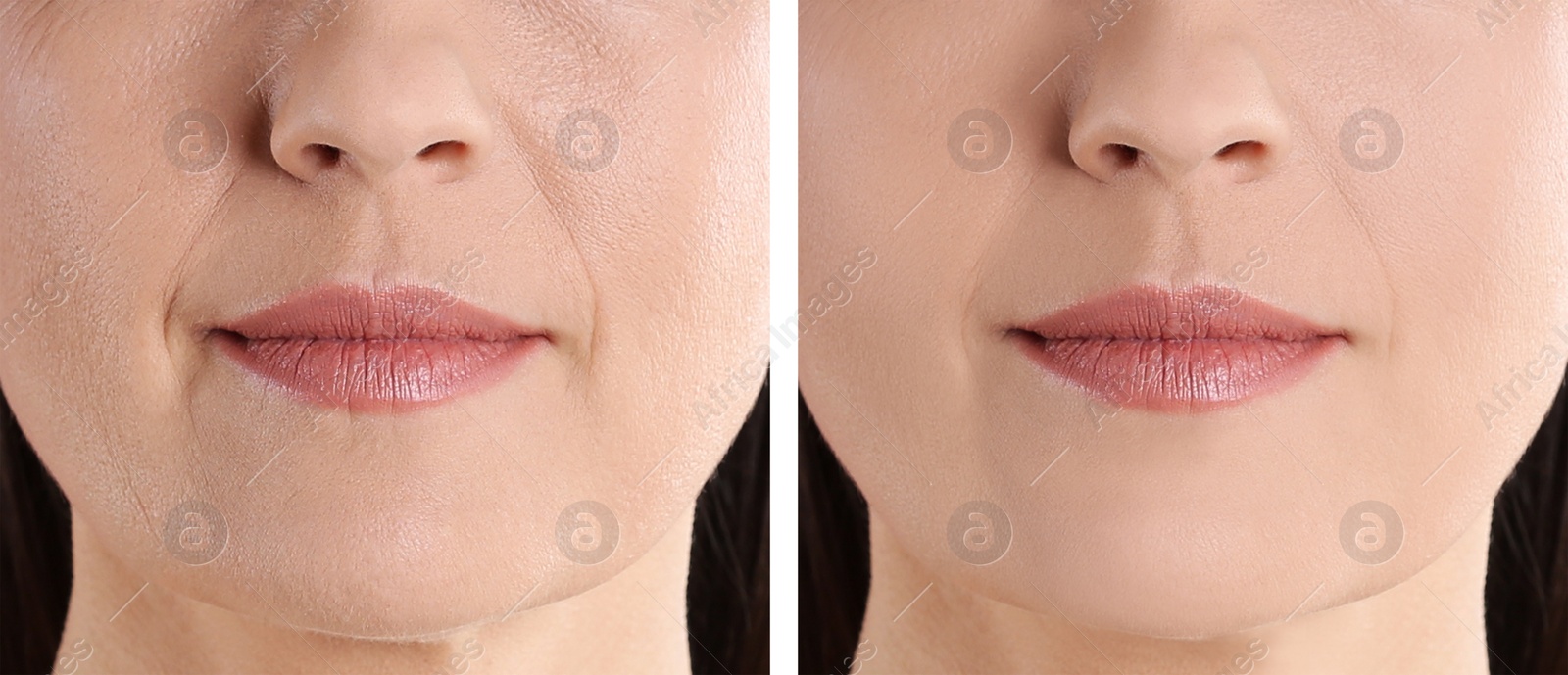 Image of Collage with photos of mature woman before and after biorevitalization procedure, closeup