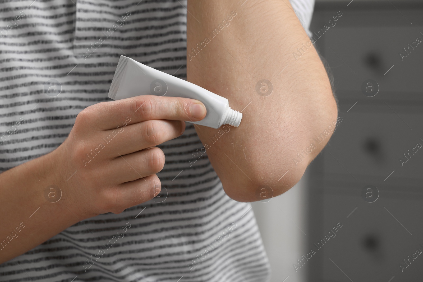 Photo of Man applying ointment from tube onto elbow indoors, closeup