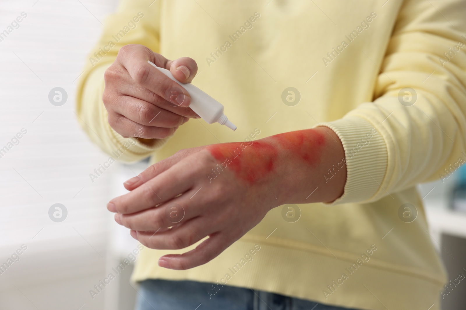 Photo of Woman applying healing cream onto burned hand indoors, closeup