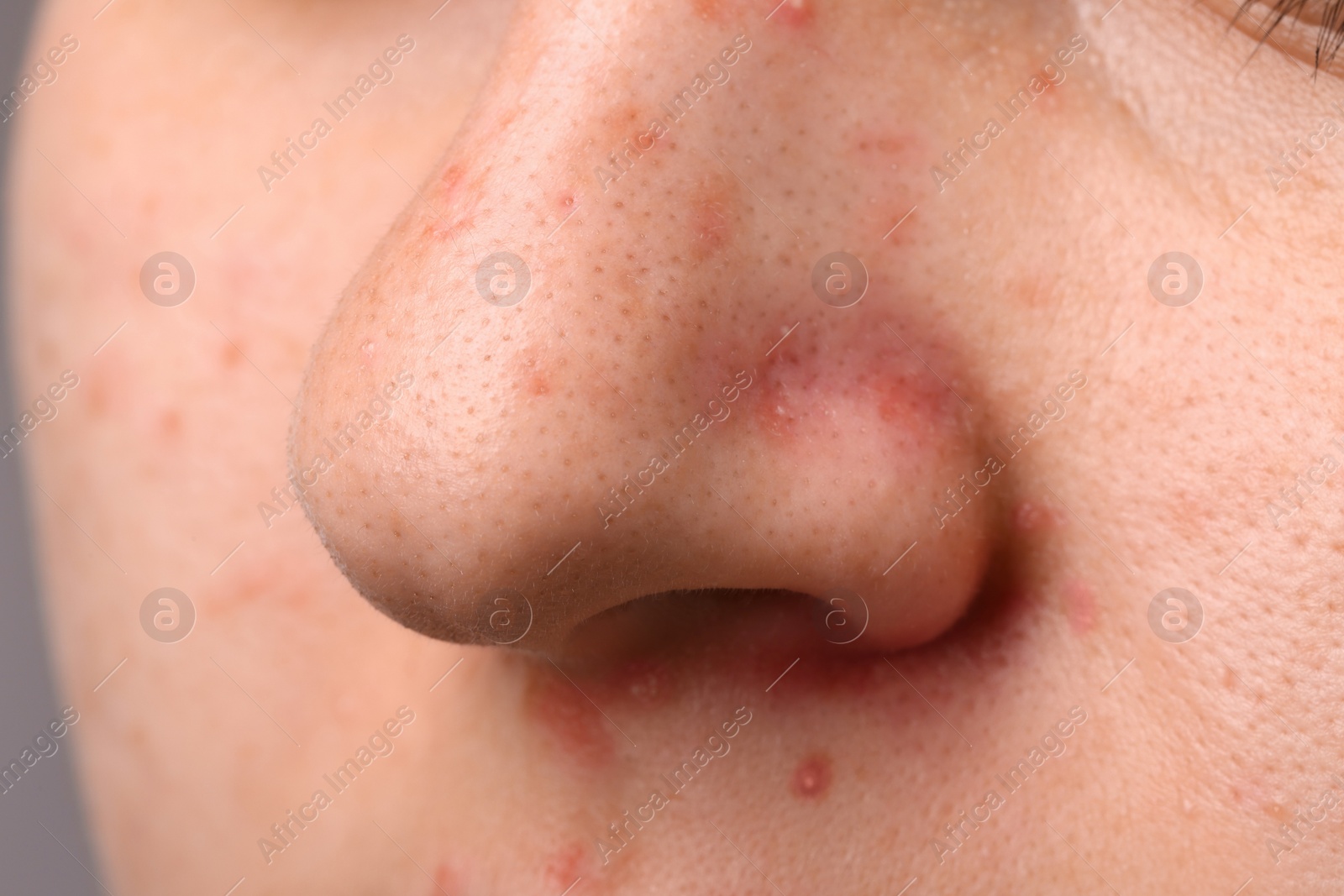 Photo of Young woman with acne problem, closeup view of nose