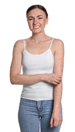 Woman with rash suffering from monkeypox virus on white background