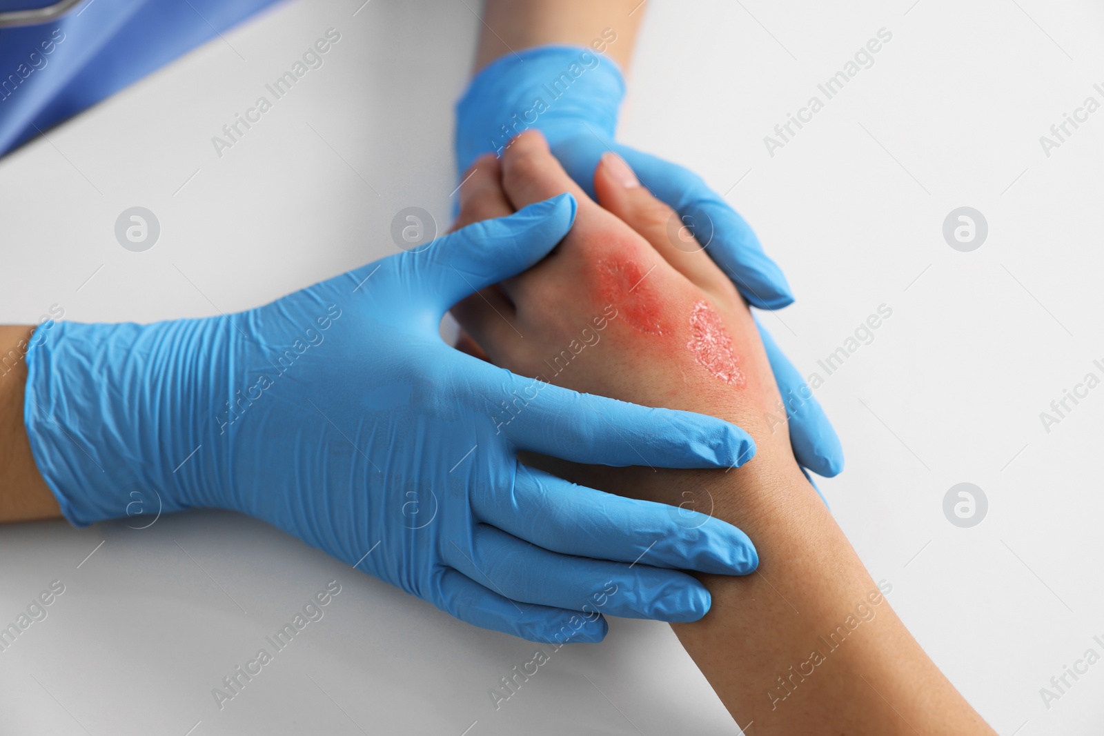 Photo of Doctor examining patient's burned hand at table, closeup