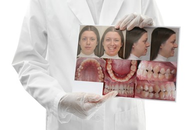 Doctor holding photo of woman and her teeth from different sides on white background, closeup