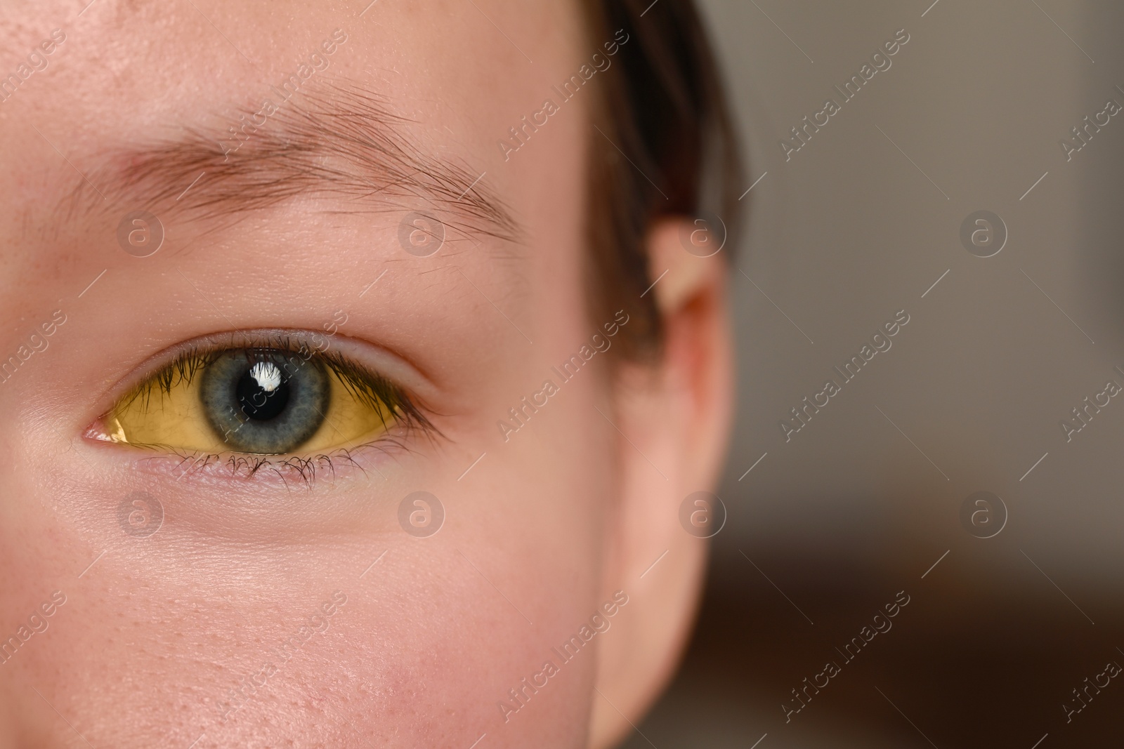 Photo of Woman with yellow eyes on blurred background, closeup. Symptom of hepatitis