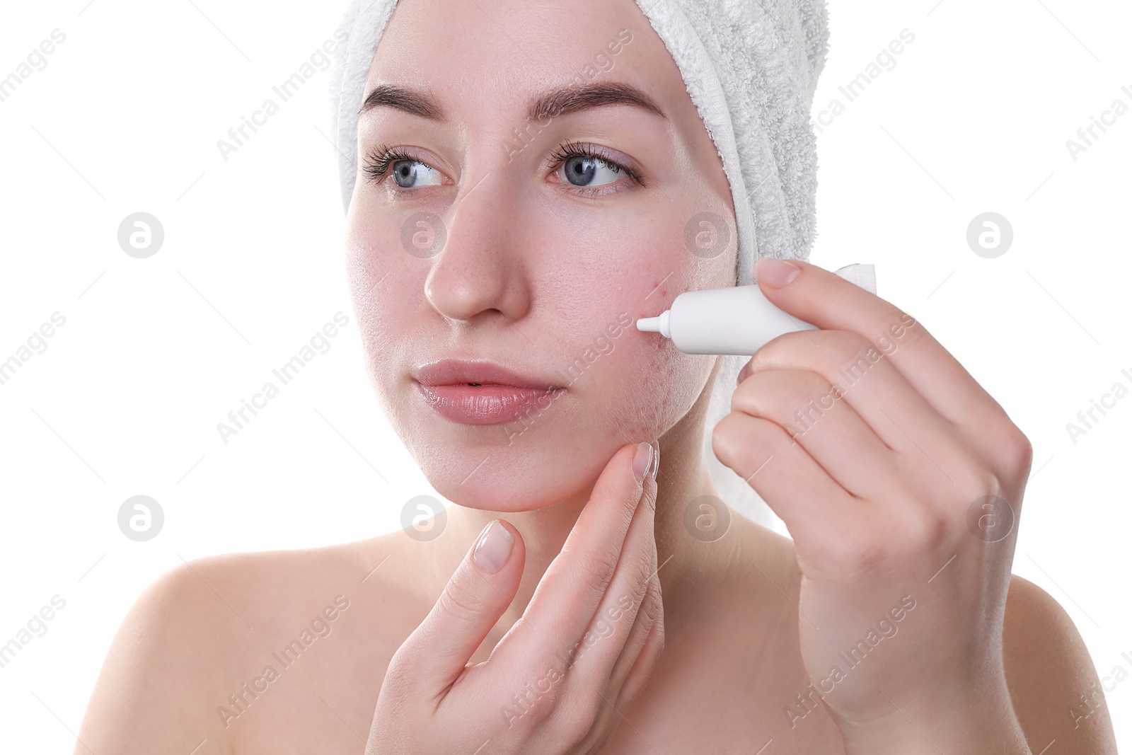 Photo of Young woman with acne problem applying cosmetic product onto her skin on white background