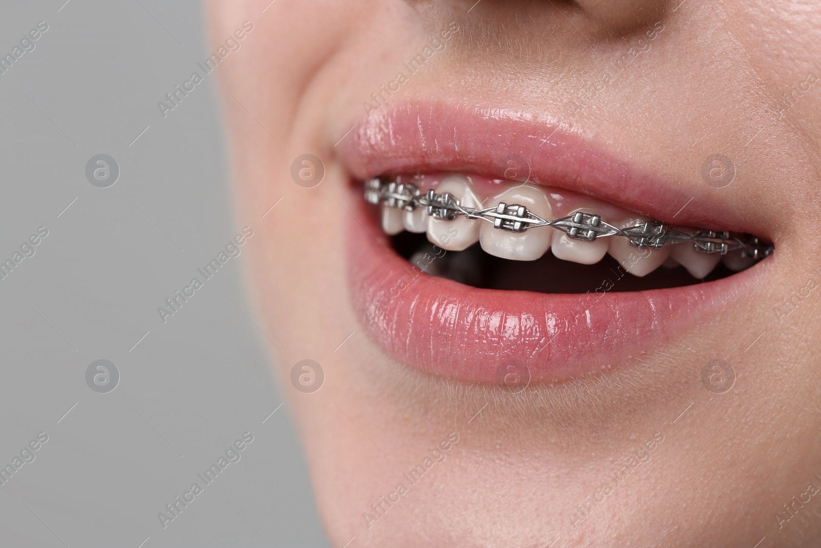 Photo of Smiling woman with dental braces on grey background, closeup