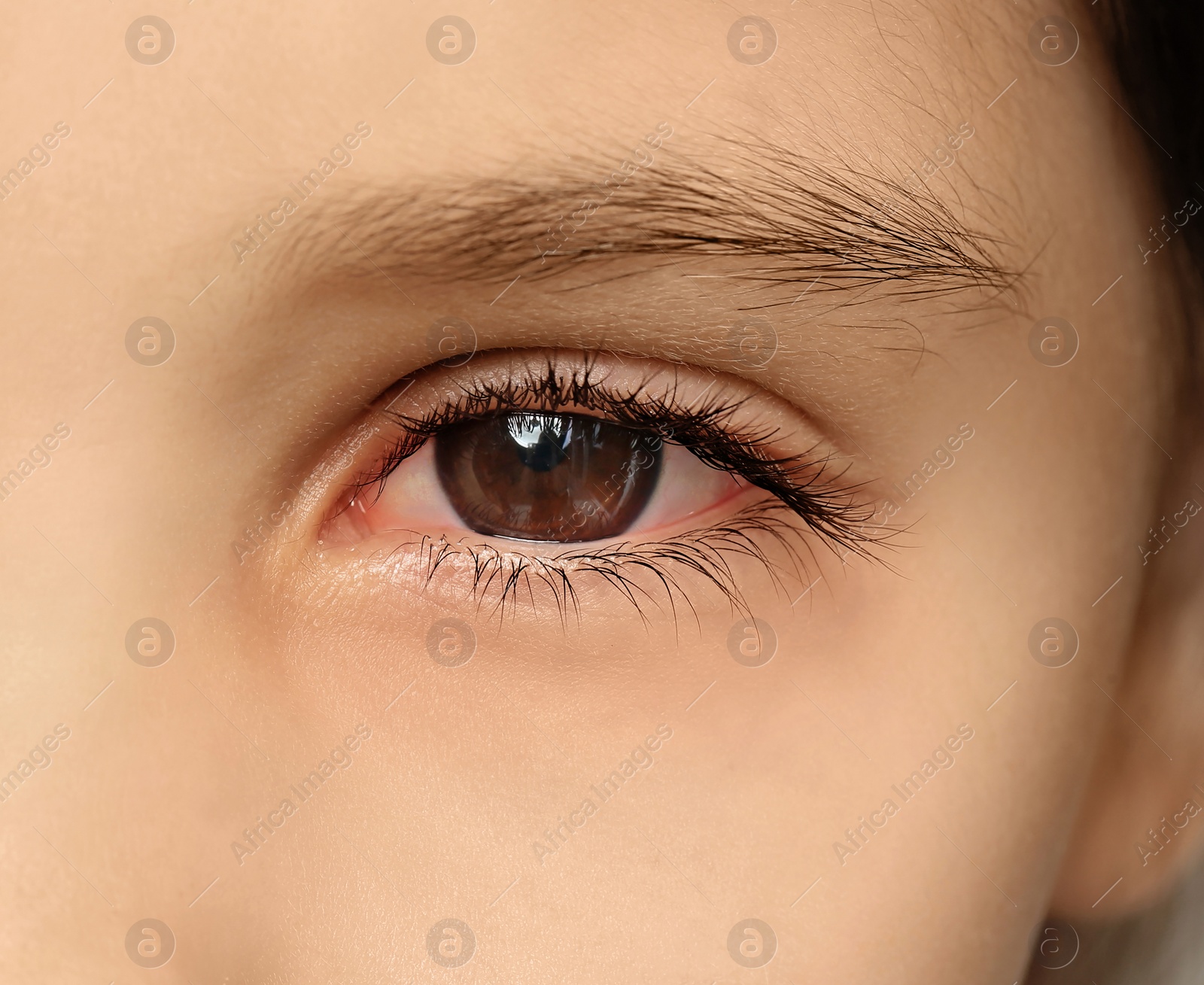 Image of Little child suffering from conjunctivitis, closeup view