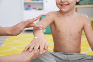 Photo of Woman applying cream onto skin of little boy with chickenpox at home, closeup