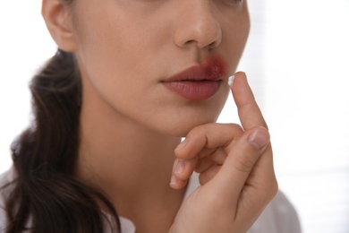 Photo of Woman with herpes applying cream on lips against light background, closeup