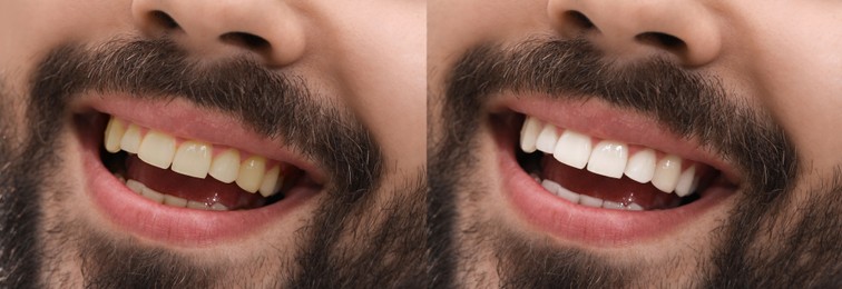 Collage with photos of man before and after tooth whitening, closeup