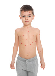 Photo of Little boy with chickenpox on white background