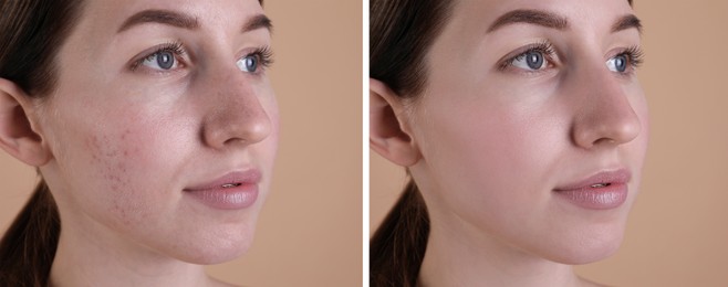 Image of Acne problem. Young woman before and after treatment on beige background, collage of photos