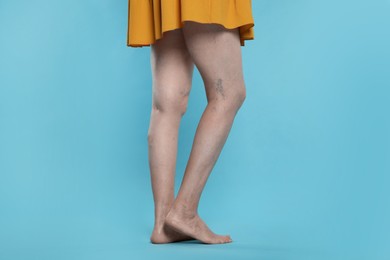 Photo of Closeup view of woman with varicose veins on light blue background