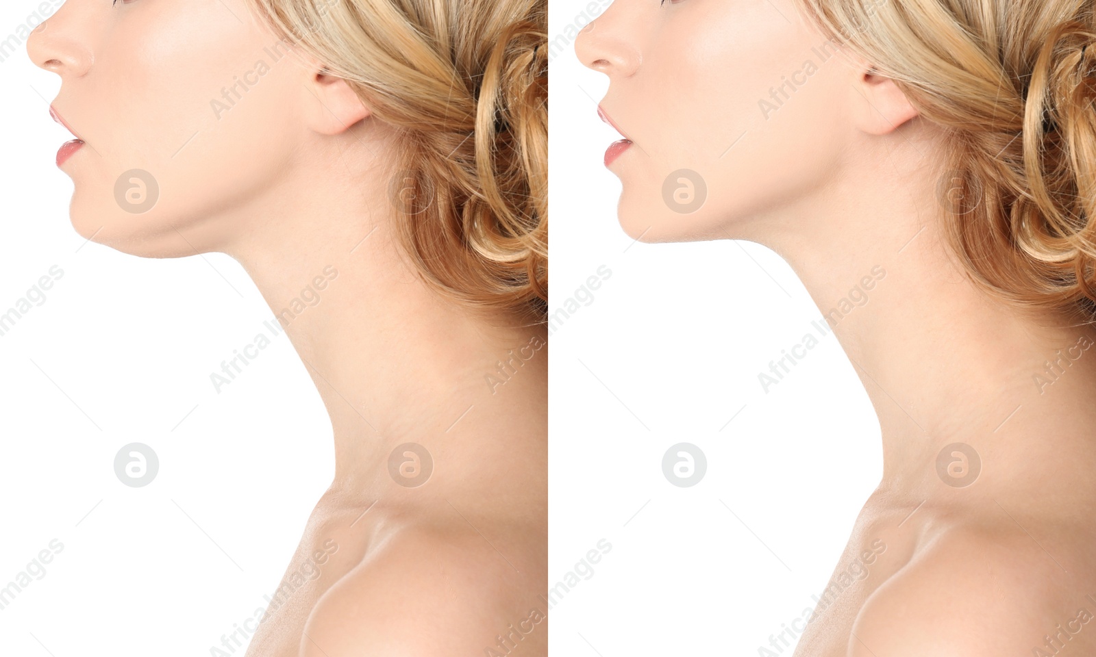 Image of Double chin problem. Collage with photos of young woman before and after plastic surgery procedure on white background, closeup