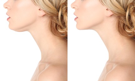 Image of Double chin problem. Collage with photos of young woman before and after plastic surgery procedure on white background, closeup