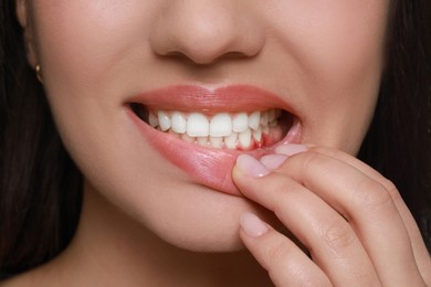 Woman showing inflamed gum, closeup. Oral cavity health
