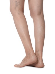 Photo of Closeup view of woman with varicose veins on white background