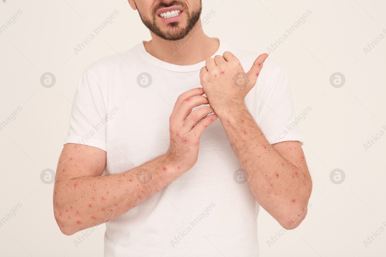 Photo of Man with rash suffering from monkeypox virus on beige background, closeup