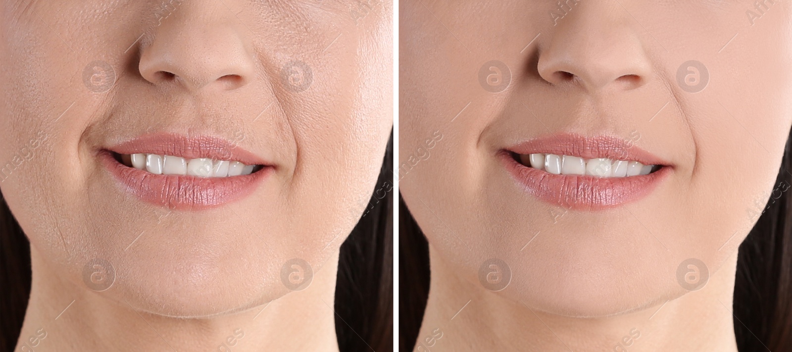 Image of Collage with photos of mature woman before and after biorevitalization procedure, closeup