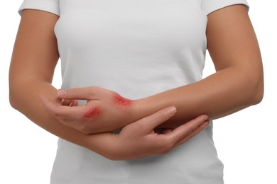 Photo of Woman with burned hand on white background, closeup