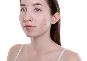 Young woman with acne problem on white background