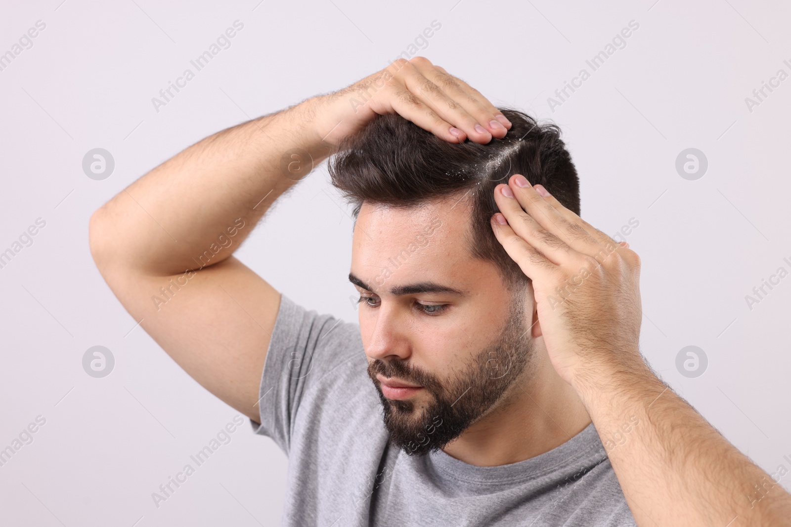 Photo of Man with dandruff in his dark hair on light grey background