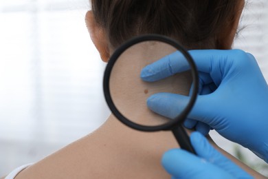 Photo of Dermatologist examining patient's birthmark with magnifying glass in clinic, closeup view